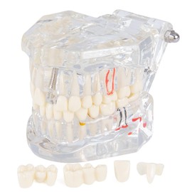 LVCHEN Modelo de dientes de implante dental transparente, modelo de dientes de enfermedad transparente, modelo de dientes patológicos con dientes extraíbles para estudio dental y educación
