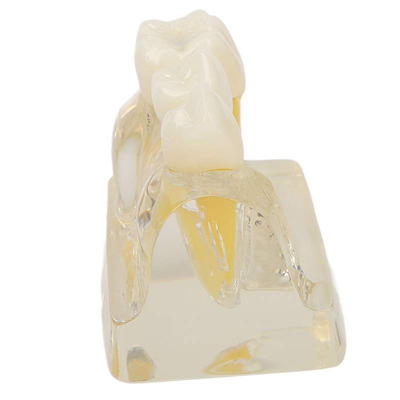 Teeth Implant Model Transparent Dental Teaching Research Demonstration Teeth Model