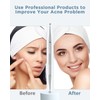 BESTOPE Blackhead Remover Blackhead Removal Pimple Comedone Extractor Tool -