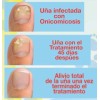 Fungicida Uñas Con Hongos, Negras, Amarillas, Onicomicosis