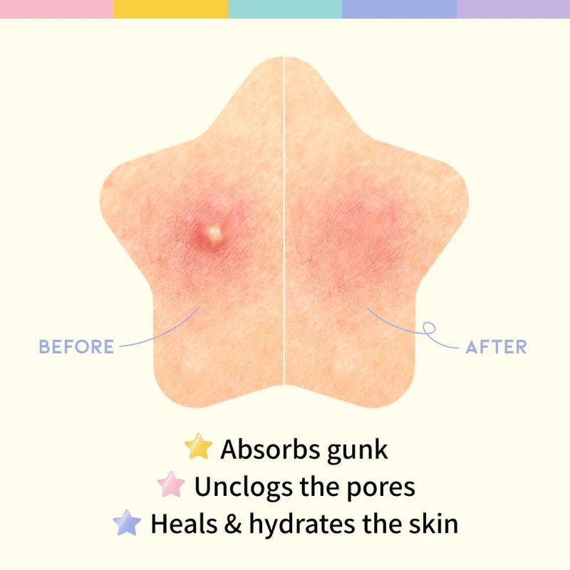 Parche Facial Star Spot Para Acné Y Granos, Hidrocoloide, Ni