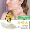 MEDca Acne Pimple Master Patch Absorbing Cover 24 Count Three Sizes