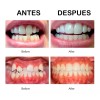 Universo en Linea Retenedor De Dientes Para Corrección De Sonrisa