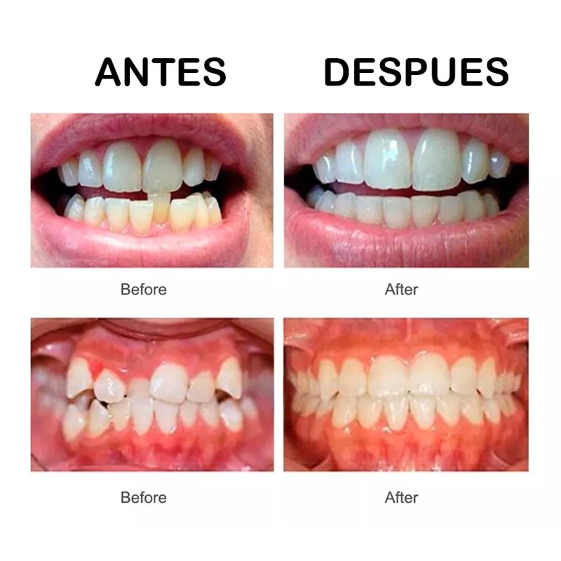 Universo en Linea Retenedor De Dientes Para Corrección De Sonrisa
