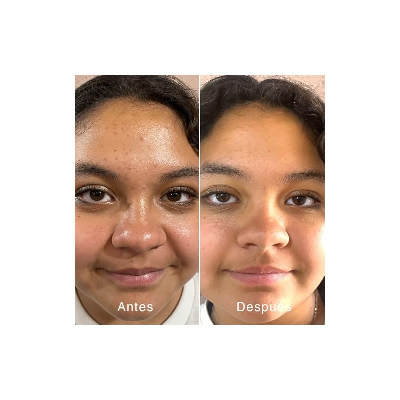 Serum Facial Piel Grasa, Oil Control, NIACINAMIDA (vit B3), Noni,