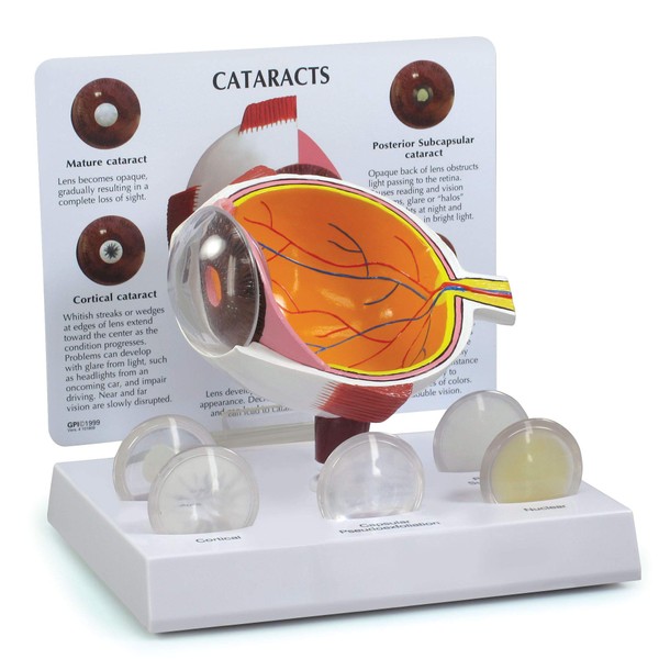 Human Cataract Eye Anatomical Model