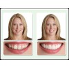 Dr. Bailey's Secure Instant Smile Upper -One Size Fits Most