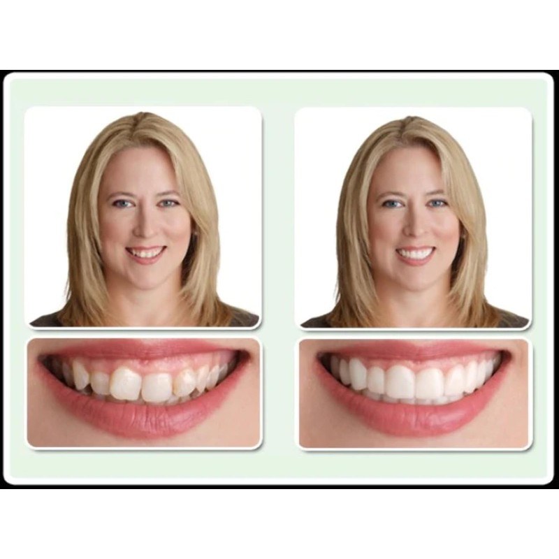 Dr. Bailey's Secure Instant Smile Upper -One Size Fits Most