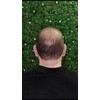 Volosy 5 Pack Fibras De Cabello Para Disimular Calvicie 28g