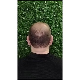 Volosy 5 Pack Fibras De Cabello Para Disimular Calvicie 28g