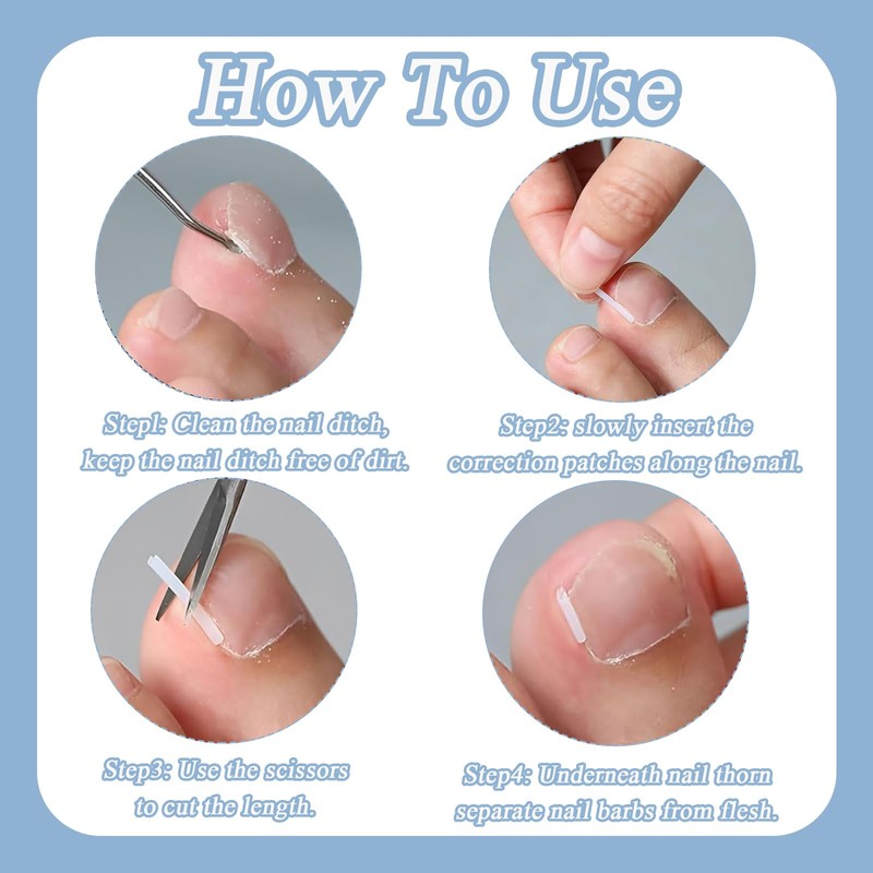 Pack of 150 Nail Clips Toenails, Ingrown Toenail Correction, Nail
