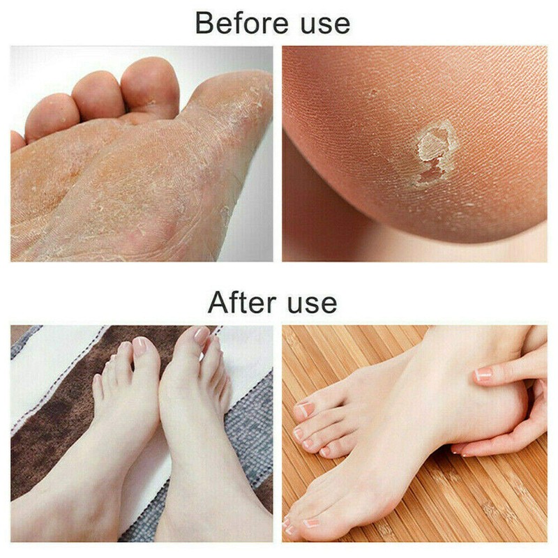 LUPO Foot Callus Rasp File Pedicure Hard Dead Skin Remover