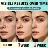 Tratamiento Para El Acné Facial, Crema Antiacné, Crema Para
