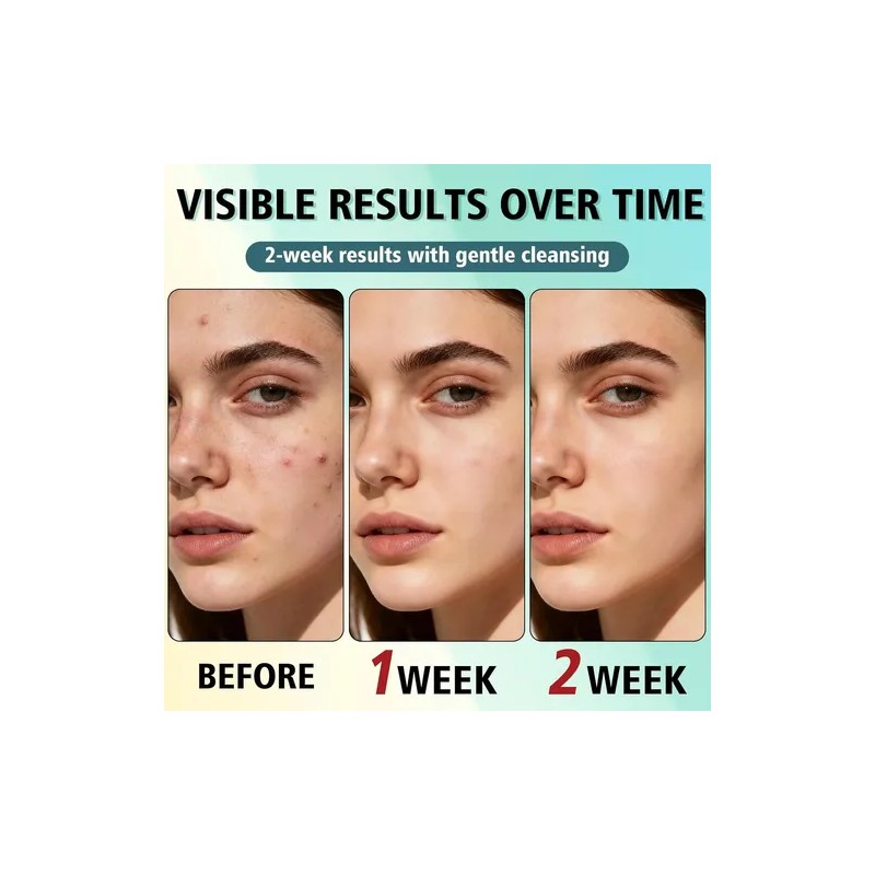 Tratamiento Para El Acné Facial, Crema Antiacné, Crema Para