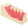 Right Lower Posterior Tooth Model 2X Magnification Detachable Resin Tooth