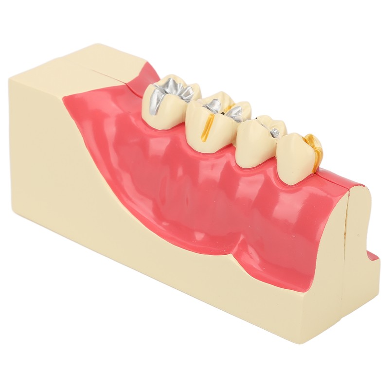 Right Lower Posterior Tooth Model 2X Magnification Detachable Resin Tooth