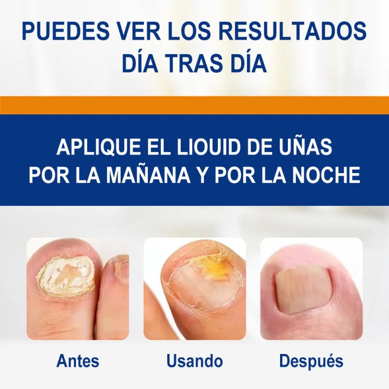 Kit 2 Uñas Hongo Líquido-inhibición 99% Hongos 30ml*2