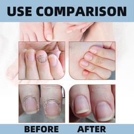 BigyQiu Nail Growth and Repair Serum,Onyxoguard Nail Growth and Repair Serum,Onyxoguard Nail Growth Serum,Nail Repair Serum,Nail Strengthener for Damaged Nails,Nail Hardener for Growth and Strength