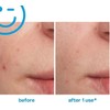 Kate Somerville EradiKate Blemish Treatment, Blemish Remover, Clears Blemishes, Spots