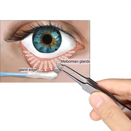 Meibomian Gland Expressor Stainless Steel Eyelid Massage Tweezers for Dryeye Extraction Tool