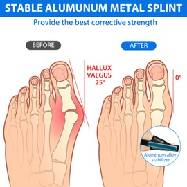 Pack of 2 Hallux Valgus Correction Splint Hallux Valgus Bandage Hallux Valgus Splint Hallux Valgus Correction Splint for Men and Women (Black)