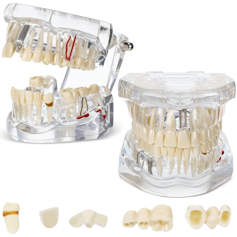 Outus Disease Teeth Model Dental Implant Teeth Model with Removable