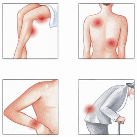 Medosan MedoFlex Gel 150 ml in Pressure Dispenser