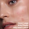 Daolyo Large Hydrocolloid Pimple Patches - 210 Count