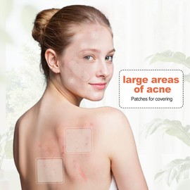 Cabiuty Large Pimple Patches for Face, 3 Sizes Hydrocolloid Acne Patches for Zits and Blemishes on Face, Chin, Back. All Skin Types