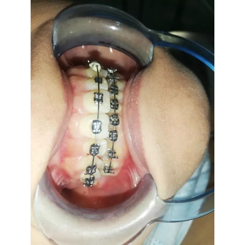 Borgatta Teens 10 Cepillos Dental Inter Ortho Teens Brackets Ortodoncia