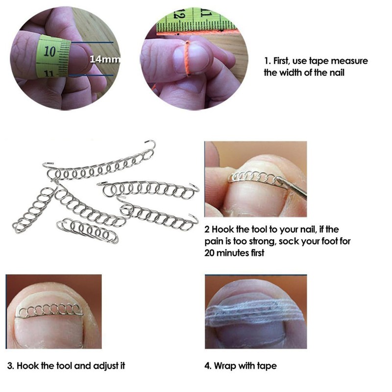 Suweiyuanshiyi Ingrown Toenail Removal Kit,Ingrown Toenail Corrector Tools Come with