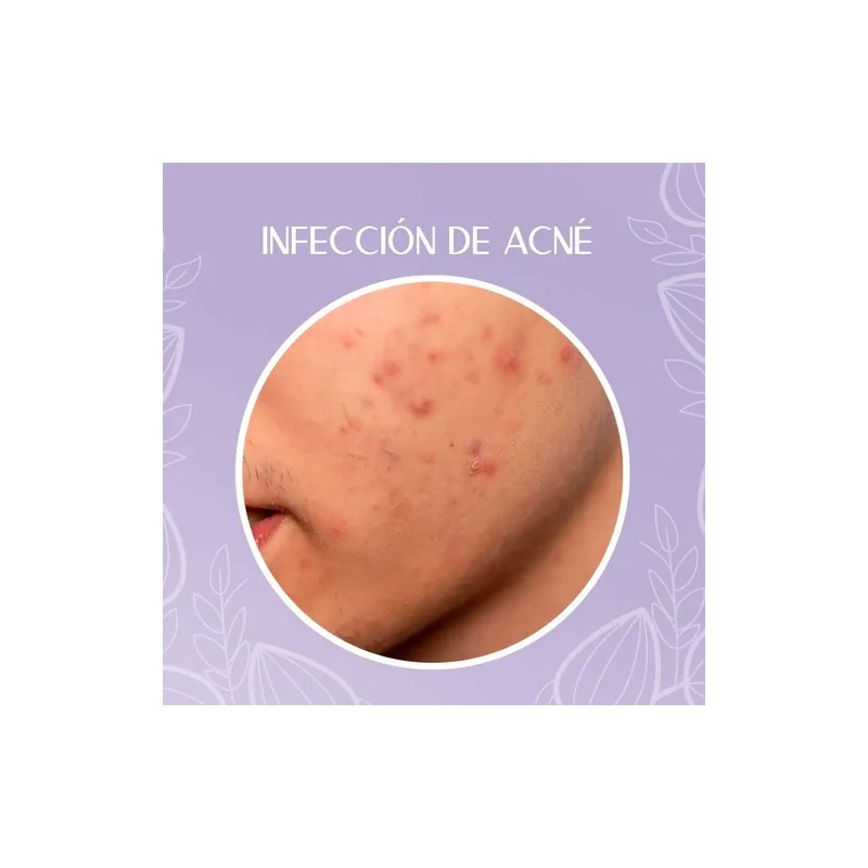 Crema Despigmentante Para Manchas, Melasma, Acné Y Paño