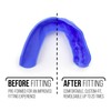 3D Mouth Guard