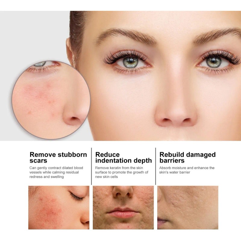 Niacina Suero Facial Desvanece Marcas De Acné Hidratación