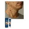Crema Quitar Verrugas Genitales Efectiva 20g