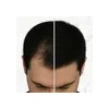 Kit 2 Tónico Capilar Crecimiento Cabello Anticaída Capixyl