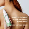 CIZ Body Acne Spray, Herbal Formula, 2%Salicylic Acid, Tea Tree