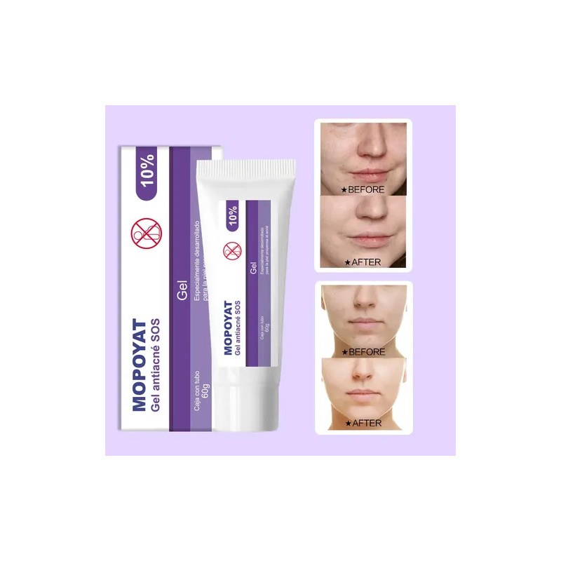 3pcs Gel Peróxido Benzoilo 10% Elimina Acné Puntos Negros