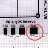 ECG RULER Pocketcard - Transparent EKG Calipers 7 Step Ruler