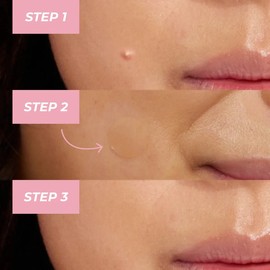 MCoBeauty Clear Miracle Xtreme Day & Night Pimple Patches