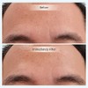 Relleno instantáneo activador juvenil