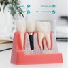 LVCHEN Modelo de implante dental – 4 veces corona puente