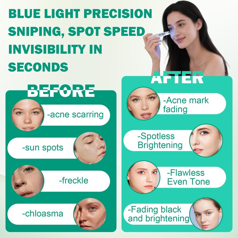 Pickelmale Entfernen, Pickelentferner, Blue Light Acne Treatment, Blaulicht Akne Entferner,