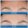 CeraVe Resurfacing Retinol Serum For Post Acne Marks, Formulated With