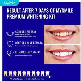 MySmile Prefilled Teeth Whitening Trays, Non-Liquid Gel Technology 12% Hydrogen Peroxide Tray for Sensitive Teeth, Enamel Safe Formulated Whiten Teeth Faster, Home Teeth Whitener System, 7 Treatments tiktok shop Oral Gentle(Result May Vary)