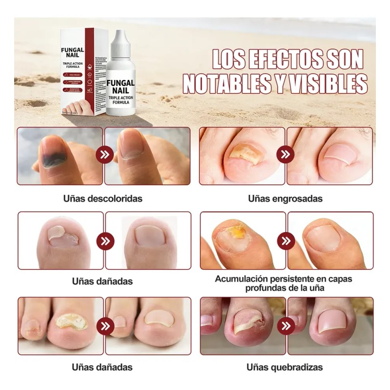 Tratamiento Para Uñas 15 Ml X2 Solución Para Cuidado De