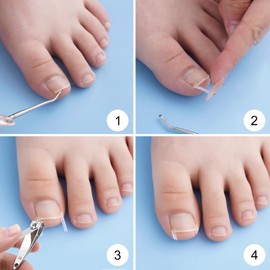 Set Zur Korrektur Eingewachsener Zehennägel,Ingrown Zehennagel Korrektur Set Mit 105 Stück C-Förmige Füllpolsterung,Einfaches Werkzeugset Für Eingewachsene Zehennägel