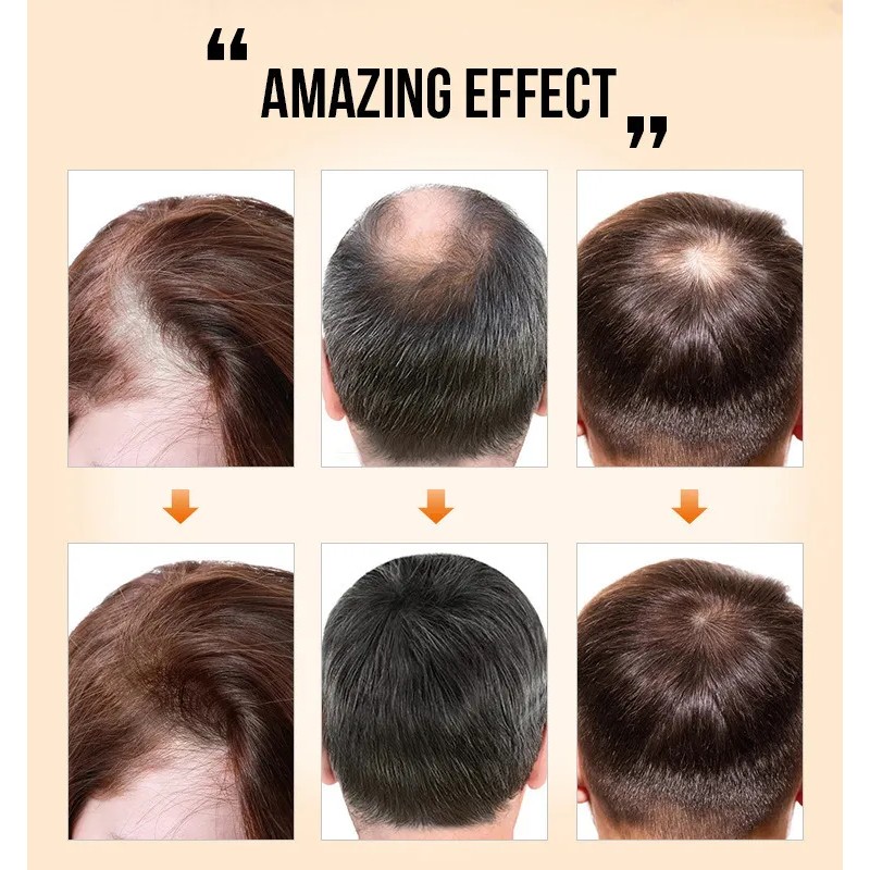 P Suero Natural For El Crecimiento Del Cabello Para