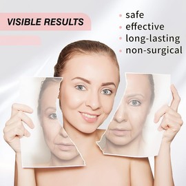 Newliky PCL Threads For Face Lift, Mono Threads Long-Lasting Skin Rejuvenation Wrinkle Removal Whole Body Lift Sharp Tips 30g38mm 20Pcs