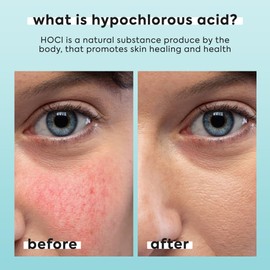 Hypochlorous Acid Spray for Face & Body - Helps Reduce Redness and Breakouts - Travel Size Hypochlorous Spray, Multi-Purpose Topical Facial Skin Repair, pH-Balancing Toner - TSA, Livaclean